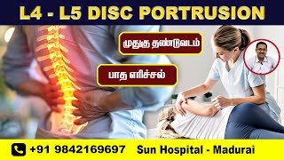 L4L5 DISC PROTRUSION  Severe Backpain  Burning Sensation  Recovery  Sun Hospital  Madurai [upl. by Mongeau377]