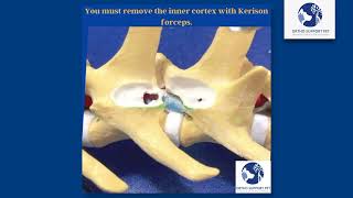 Hemilaminectomy in dogs [upl. by Stutsman]