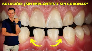 ¿Te faltan dientes y no quieres Implantes coronas o removibles Solución Caso Real [upl. by Alisia]