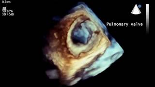 Trileaflet pulmonary valve with 3D TTE [upl. by Ilojna642]