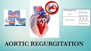 Aortic Regurgitation  Water hammer pulse  RHD [upl. by Kiona]