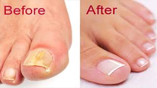 How To Prepare The Apple Cider Vinegar And Baking Soda Remedy At Home To Treat Fight Nail Fungus [upl. by Paucker]