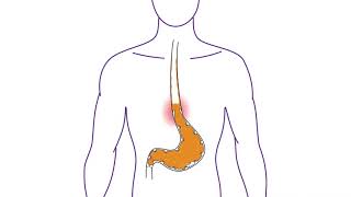 Nexium Control®  What is Heartburn [upl. by Dorita365]