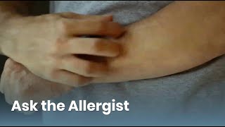 Chronic Hives Triggers and Treatment Ask the Allergist Chronic Urticaria [upl. by Eelatan]