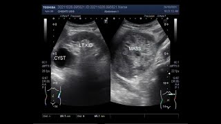 A large Adrenal tumor [upl. by Dane]