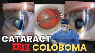 Colobomas amp Cataract Surgery  A Patients Case [upl. by Aikat]