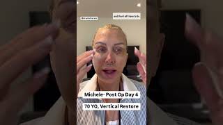 DAY 4 of Facelift Healing amp Recovery How its ACTUALLY Going [upl. by Anirhtak]