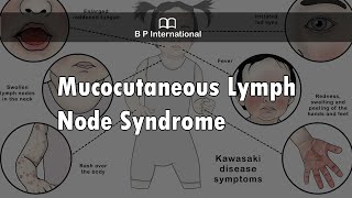 Mucocutaneous Lymph Node Syndrome [upl. by Sedgewake847]