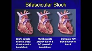 52e BiTrifasicular Block  Bradyarrhythmias Hong Kong University [upl. by Vladimir]