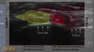 LSORA US supraclavicular block [upl. by Sorilda375]