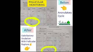 Satisfactory OVULATION STUDY results post Ayurvedic treatment [upl. by Onairpic]