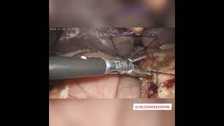 perforation peritonitislaparoscopic perforation closure [upl. by Akenor]