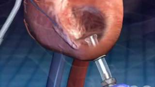 Left Ventricular Assistive Device  3D Medical Animation  ABP © [upl. by Leissam706]