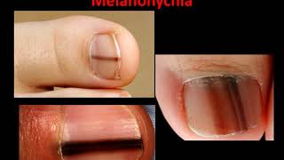 Melanoma Melanonychia  What is it [upl. by Anton]