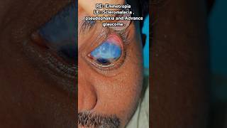 RE  Emmetropia LE  Scleromalacia  pseudophakia and Advance glaucoma [upl. by Ame]