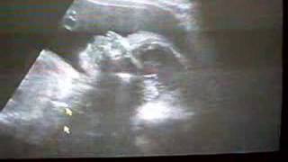 my baby boy 6 months ultrasound [upl. by Yvan]