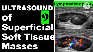 Lymphadenopathy [upl. by Prader886]