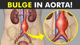 Aortic Aneurysm Explained Symptoms Causes and Treatments [upl. by Nirre635]