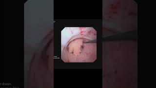 Tratamento endoscópico com LASER de tumor na pelve renal [upl. by Hussey119]