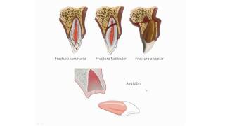 Traumatismos DentoAlveolares [upl. by Retha]