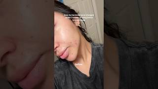 How my hormonal acne changes within 3 weeks of using turmeric soap skincare acnetreatment [upl. by Hyde]