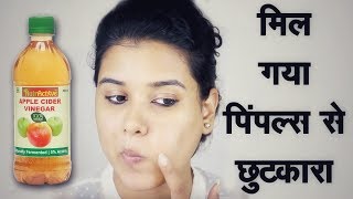 Skin Care for Acne Prone Skin Hindi [upl. by Zuleika122]