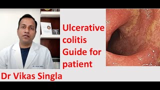 Ulcerative colitis Treatment and Symptoms अल्सरेटिव कोलाइटिस In Hindi Dr Vikas Singla [upl. by Claude]