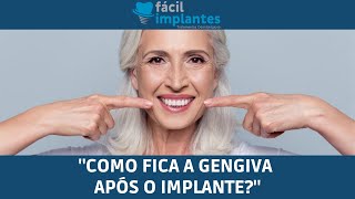 quotComo fica a gengiva após o implantequot  Fácil Implantes [upl. by Jacquelyn435]