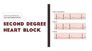 Second degree AV Block  Heart Blocks  ECG Rhythm Series [upl. by Akiras]