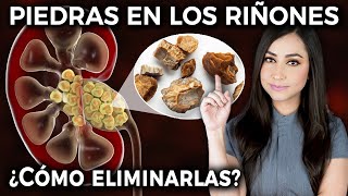 PIEDRAS EN LOS RIÑONES ¿Qué SÍNTOMAS causan y cómo ELIMINARLAS Cálculos renales👩🏻‍⚕️ drapauzuniga [upl. by Cudlip]