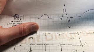 Wie verwendet man ein EKG Lineal [upl. by Graniah355]