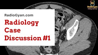 Acute Epiploic Appendagitis  Radiology Board Review Case [upl. by Urina]