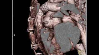 Cardiac Congenital heart disease with stent in pulmonary arteries 1 of 8 [upl. by Myra76]