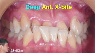 PreAligner Treatment for Class III Anterior Crossbite Correction｜【Chris Chang Ortho】CC695 [upl. by Nosoj]