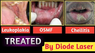 OSMForal submucos fibrosis Exfoliative Cheilitis Bellquots Palsy and Leukoplakia Treated by Laser [upl. by Silda609]