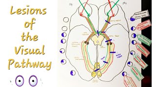 Lesions of the Visual Pathway  Optic Nerve and pathway lesions [upl. by Adnilg990]