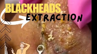 Blackheads Removal from Nose  Blackheads Extraction 😲 blackheads blackhead blackheadremoval [upl. by Irene]