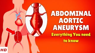 Abdominal aortic aneurysm – Causes Signs and Symptoms Diagnosis amp Treatment [upl. by Nilesoj]