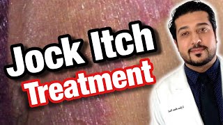 Tenia Cruris Infection Jock Itch  Causes Risk Factors Signs amp Symptoms Treatment [upl. by Anrim]