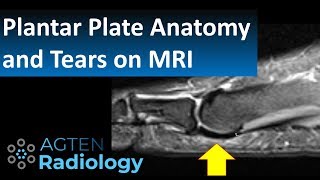 How to Assess Plantar Plate Anatomy and Tears on MRI [upl. by Akire]