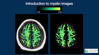 Webinar Myelin Imaging in Clinical Practice [upl. by Ilyk]