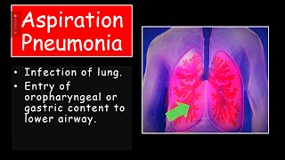 Aspiration pneumoniafor studentsRisk microbiology clinical feature diagnosis amp treatment [upl. by Vin]