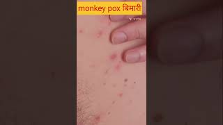 monkey pox disease are spreading all over the world  all information about monkey pox shorts [upl. by Anaxor]