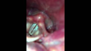 Vocal Cord and Folds Vocalising using an iphone 4 [upl. by Lezti]