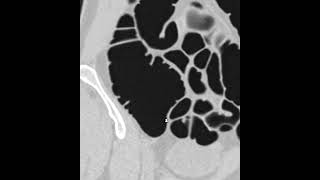 1cm polyp in the cecum [upl. by Harms600]