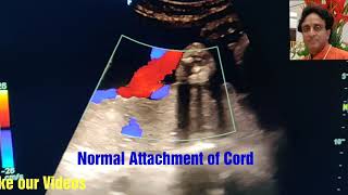 Marginal Cord Attachment to placenta How to See Tips in PregnancyUltrasound Velamentous cord [upl. by Violante]