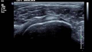 dislocating biceps tendon [upl. by Drais]