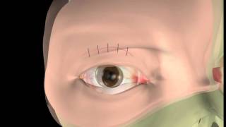 Thyroid eye disease  14 Lid surgery  The operation [upl. by Lippold406]