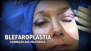 Cirurgia  Blefaroplastia  Cirurgia Plástica das Pálpebras ᴴᴰ [upl. by Bruno859]