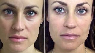 Dermal Filler Under Eyes Tear Trough [upl. by Delanie]